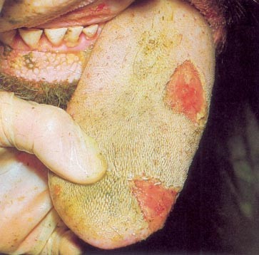 Lesions on cattle tongue